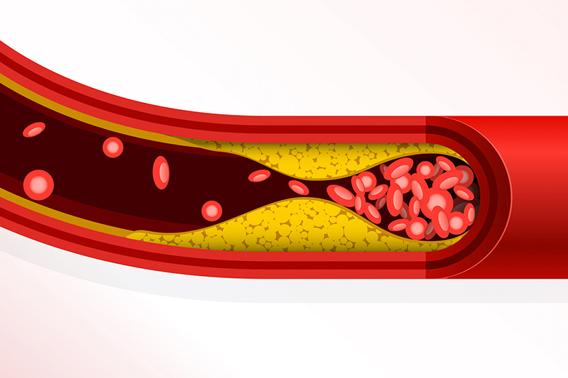cholesterol xấu bám vào thành mạch gây mỡ máu