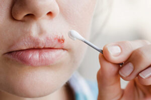Những điều cần biết về herpes môi